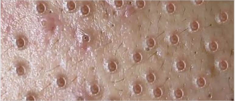 Ugly blackheads popping